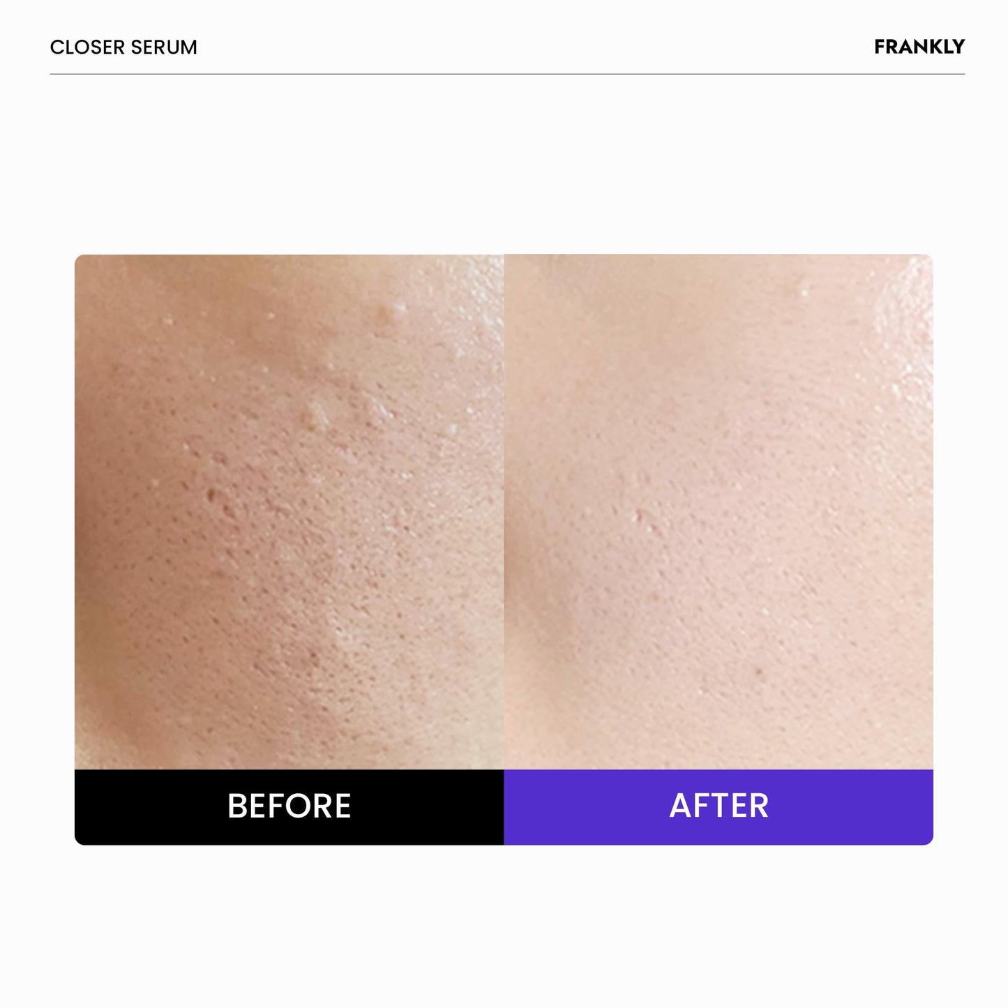 FRANKLY Closer Serum | Pore Minimizer Serum | 9 Peptides, Vegan Collagen, Adenosine, PHA | Korean Pore Minimizer for Glass Skin, Anti-Aging, Hydration, Elasticity | 1.01 fl oz - Medaid International