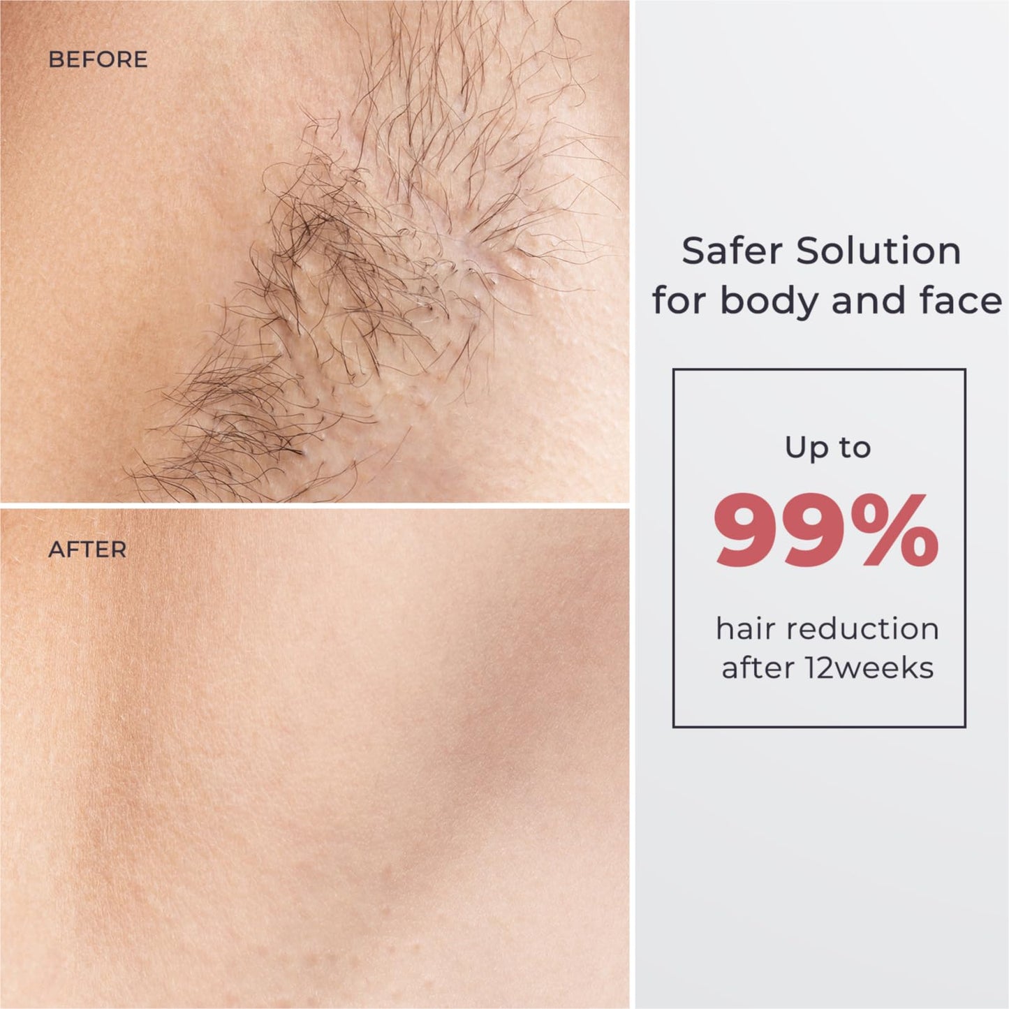 Laser Hair Removal for Women and Men, IPL with Ice-Cooling System for Nearly Painless And Long-Lasting Result At-Home Permanent Hair Removal Device 999999 Flashes for Whole Body Use - Medaid International
