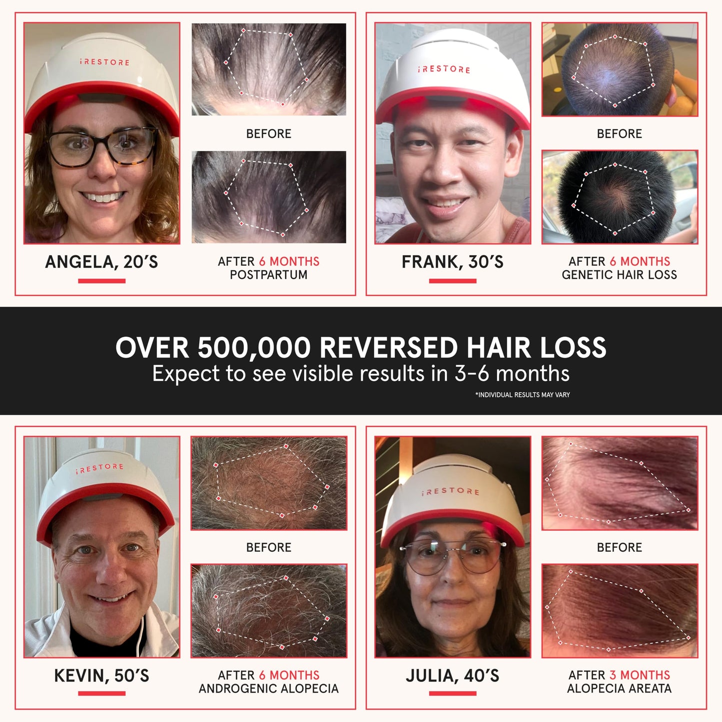 iRestore Professional + Rechargeable Battery Pack - Laser Red Light Therapy for Hair Growth - FDA Cleared Hair Loss, Thinning Treatment for Men & Women - Hair Regrowth Cap - 282 Lasers & LEDs - Medaid International