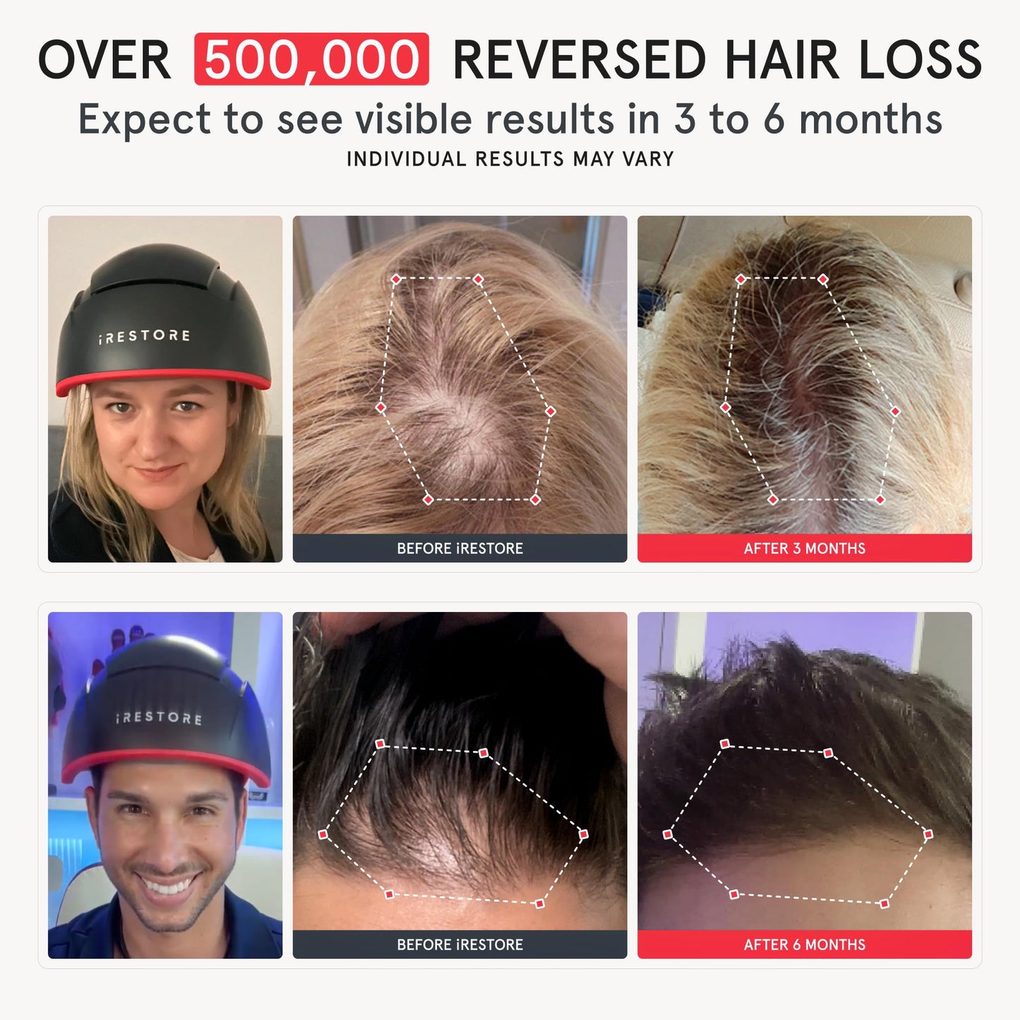 iRestore Elite + Rechargeable Battery Pack - Laser Red Light Therapy for Hair Growth - FDA Cleared Hair Loss, Hair Thinning Treatment for Men & Women - Hair Regrowth Laser Cap - 500 Lasers & LEDs - Medaid International