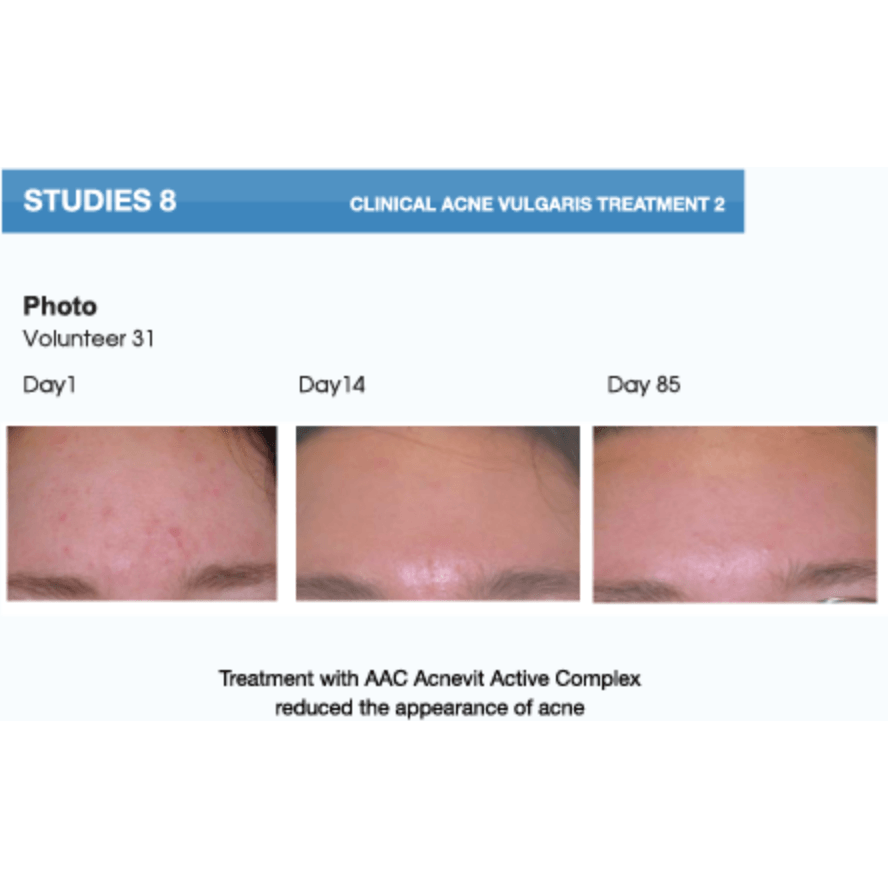 AcneVit Anti-Acne Skin Perfecting Serum with Vitamin C & Niacinamide