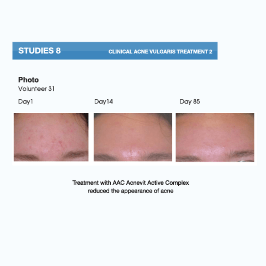 AcneVit Anti-Acne Cleansing Gel