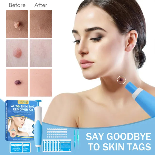 Skin Tag Removal Kit | Made In United Kingdom طقم إزالة الزوائد الجلدية | صنع بريطاني
