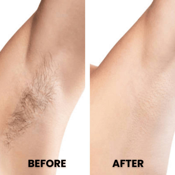 Sonax Pro™ Epilator | Hair-Free - Medaid International