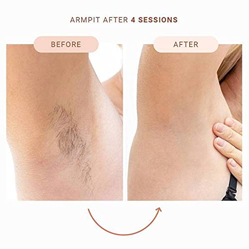 Skinna IPL Laser Hair Removal System | Laser Hair Remover, Permanent Hair Removal for Women & Men | Hair Laser Removal at Home for Face, Arms, Legs, Body, Bikini Line | Painless Hair Removal Laser - Medaid International