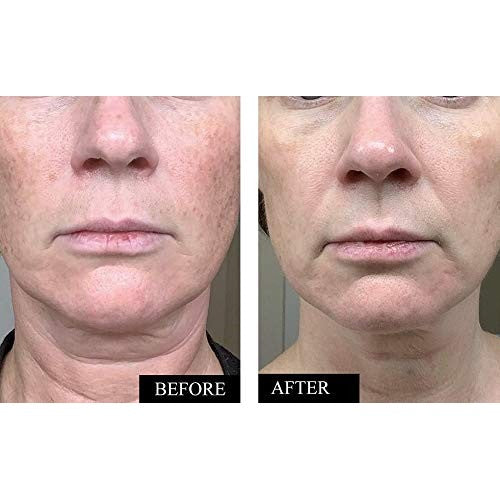 Kleem Pure Vitamin C Serum for Face for Women with Hyaluronic Acid & Vitamin E | Anti Aging Serum to Boost Collagen, Reduce Wrinkles, Acne, Dark Spots & Sun Damage | Made in USA | 1.7 Oz - Medaid International