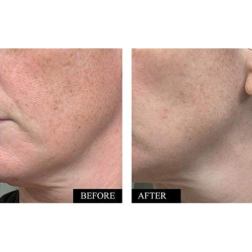 Kleem Pure Vitamin C Serum for Face for Women with Hyaluronic Acid & Vitamin E | Anti Aging Serum to Boost Collagen, Reduce Wrinkles, Acne, Dark Spots & Sun Damage | Made in USA | 1.7 Oz - Medaid International