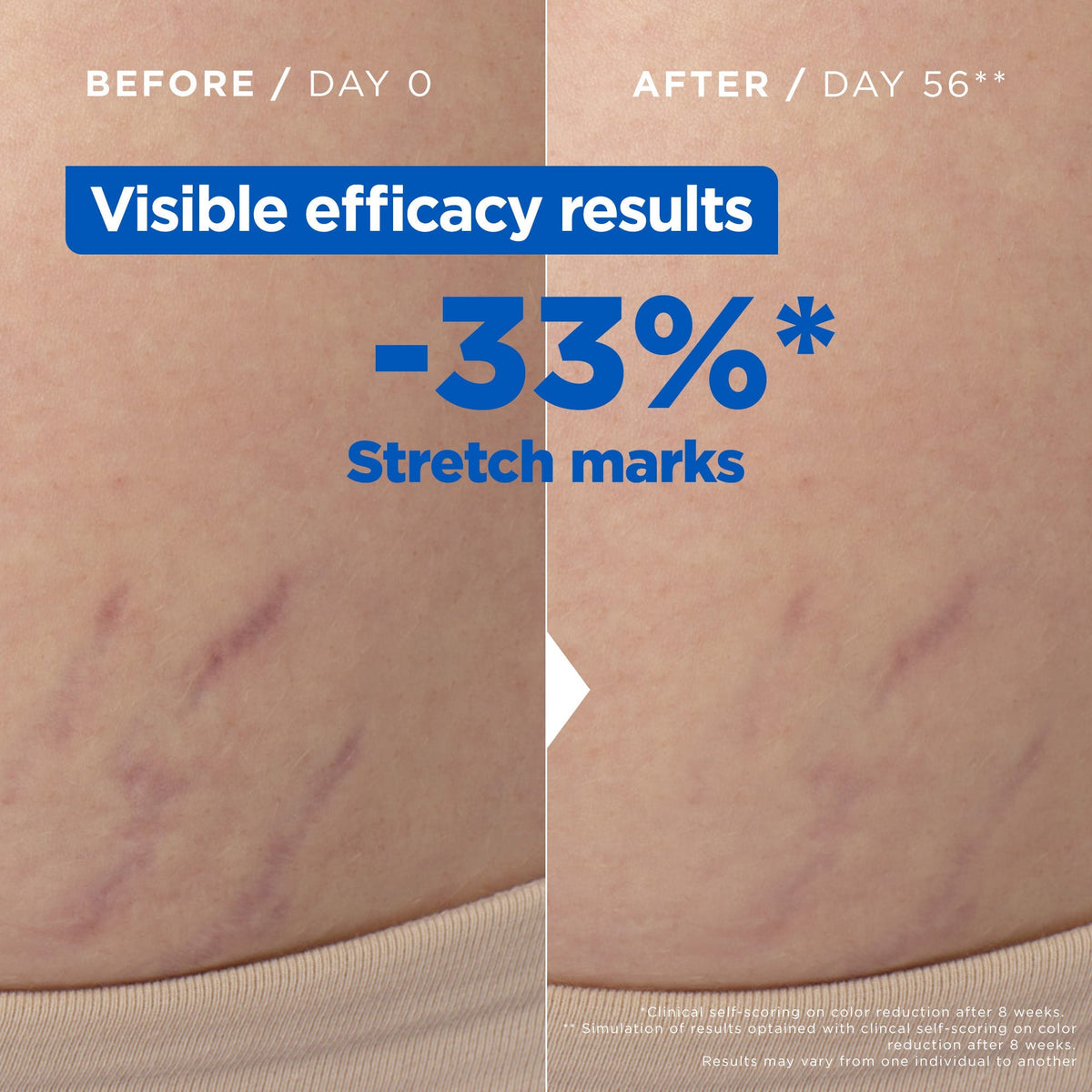 Mixa Anti Stretch Mark Oil - For Skin with Stretch Marks - With Omega 6 & 9 - 100 ml