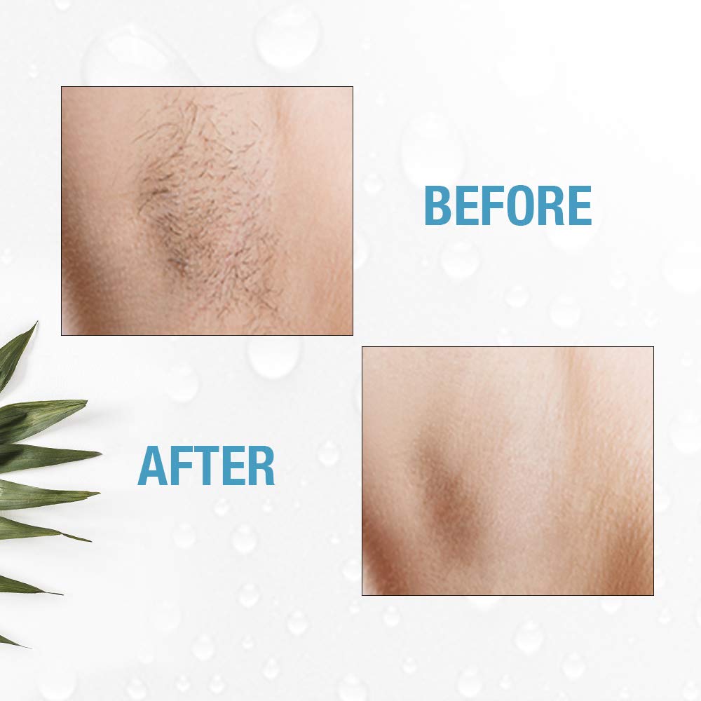 Clean + Easy Electrolysis Machine for Permanent Hair Removal - Non-Laser, Painless Electrolysis Hair Removal for Face & Body, At-Home Remover Device - Medaid International