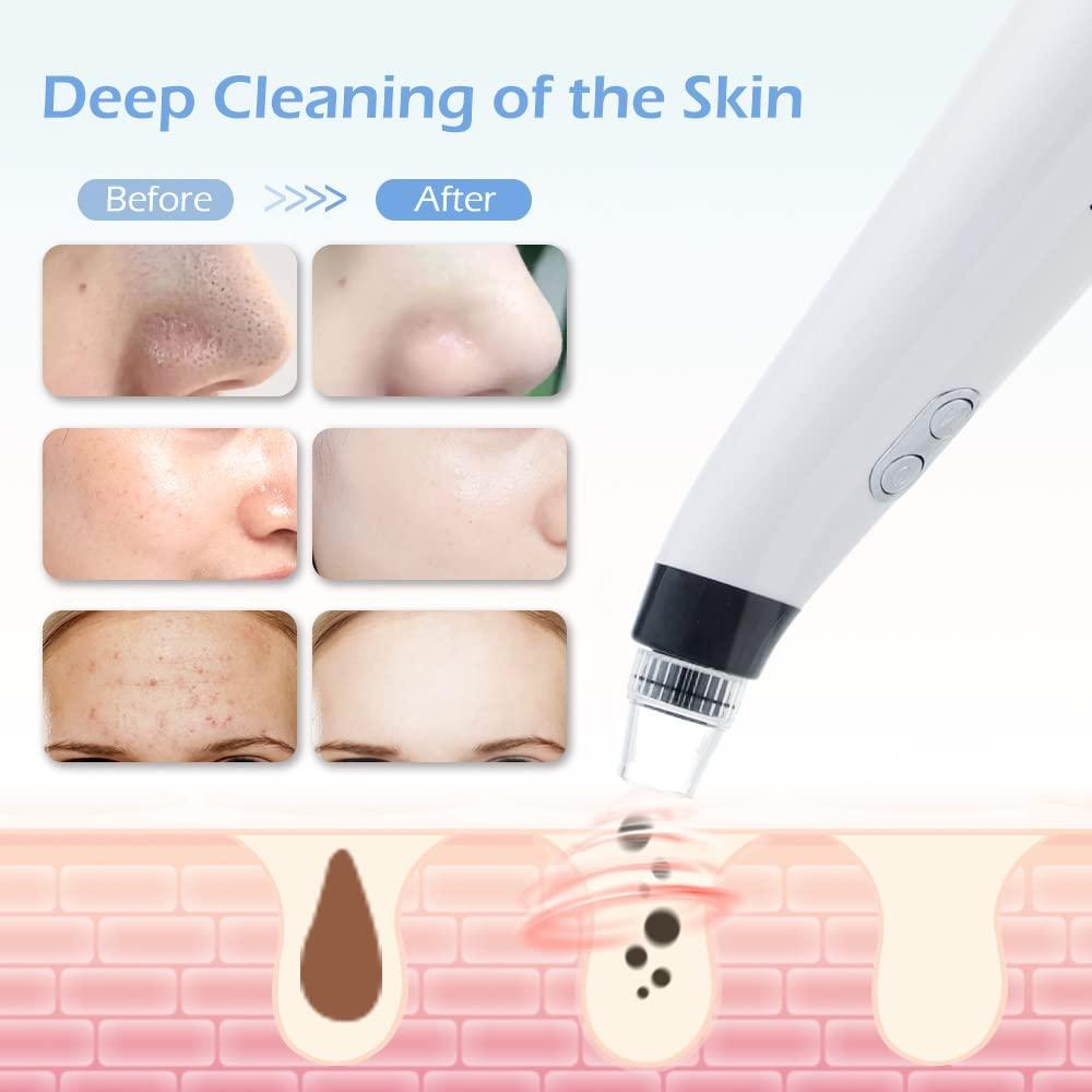 Black head Remover Device