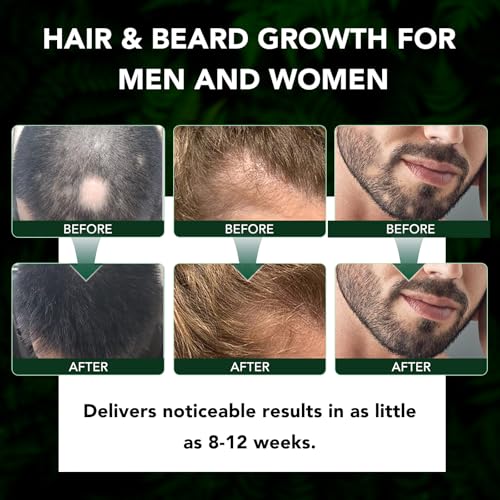 Minoxidil for Men and Women Hair Growth Spray, 5% Minoxidil Beard Growth Oil, Advanced Hair Regrowth Serum Topical Solution Spray Treatment for Hair Loss, Thinning, Hair Regrowth & Thicker 2.02 fl.oz - Medaid International
