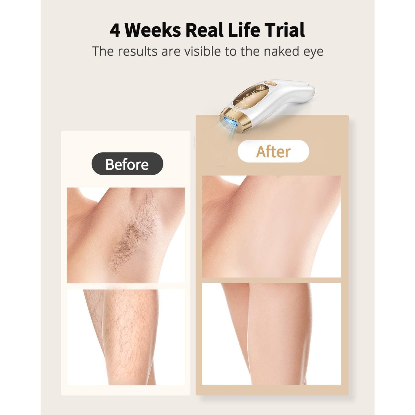 UENMOON Laser Hair Removal for Women and Men - IPL Hair Removal with Ice-Cooling System for Painless & Long-Lasting Result, Whole Body Hair Removal - Medaid International