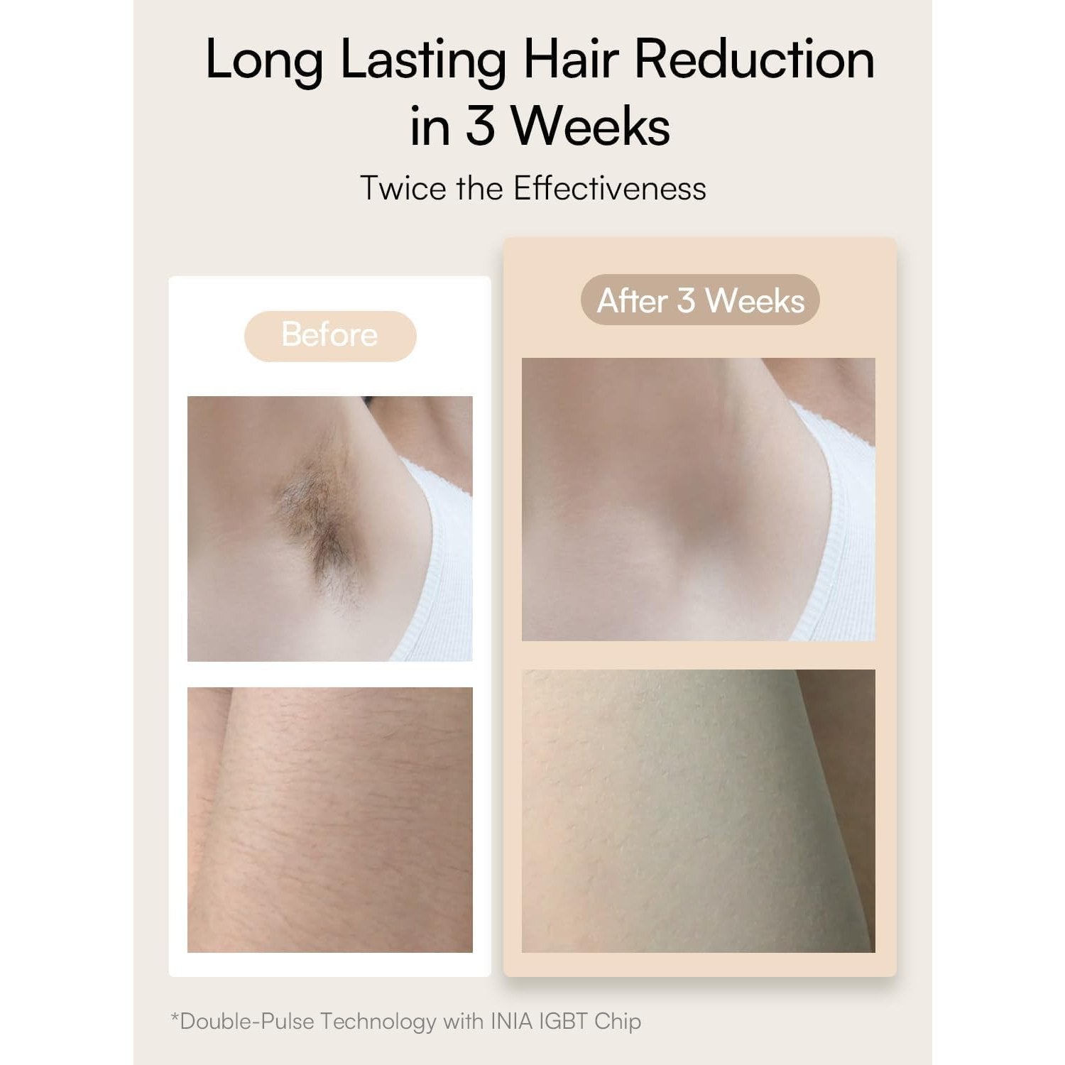 Laser Hair Removal for Women and Men, IPL Hair Removal Device with Ice-Cooling, Double Effectiveness & 5 Flashes per Second for Long-Lasting and Nearly Painless Results - Medaid International