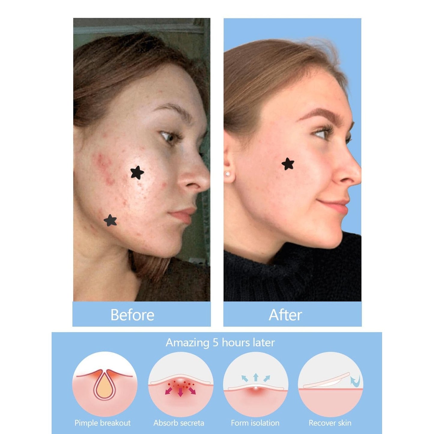Black Star Pimple Patches for Face, 153 Counts Hydrocolloid Star Acne Patches, Cute Zit Covers for Face, Spot Stickers with Tea Tree, Salicylic Acid and Cica Oil - Medaid International