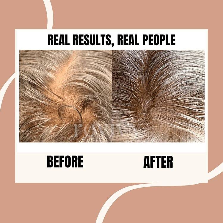 REVIVV Roller for Hair Rejuvenation – 0.25mm Roller for Scalp, Hair, Beard, Skin – 45 Day Supply - Medaid International