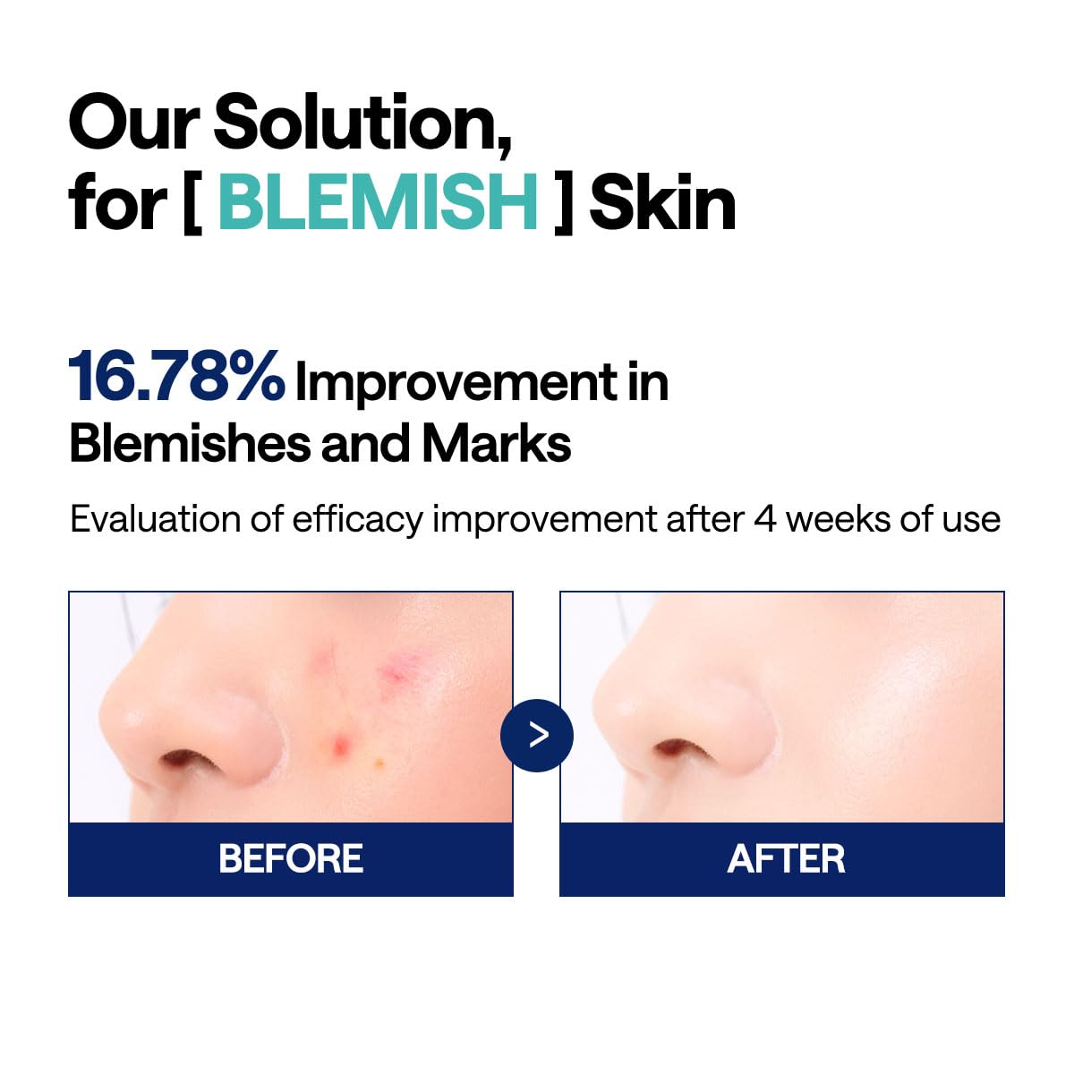 MEDIHEAL Toner Pads [Madecassoside] - Blemish Care Toner Pad with Centella Asiatica - Improves Uneven Skin Tone & Deep Hydration - Vegan Hypoallergenic Face Gauze (100 Count) - Medaid International