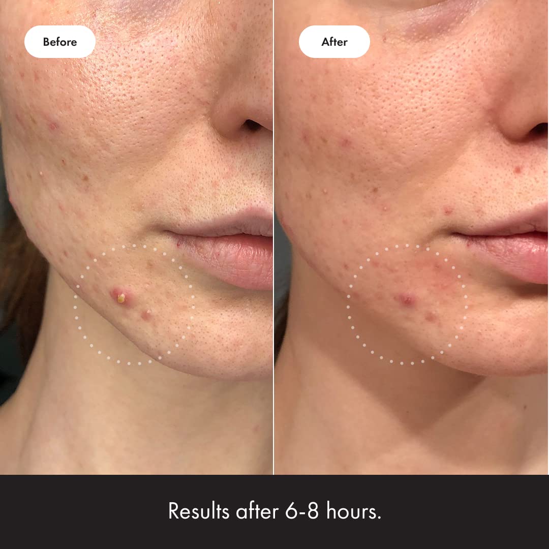 Mighty Patch™ Invisible+ Patch - Daytime Hydrocolloid Acne Pimple Patches for Covering Zits and Blemishes, Ultra Thin Spot Stickers for Face and Skin (24 Medium and 15 Small Patches) - Medaid International