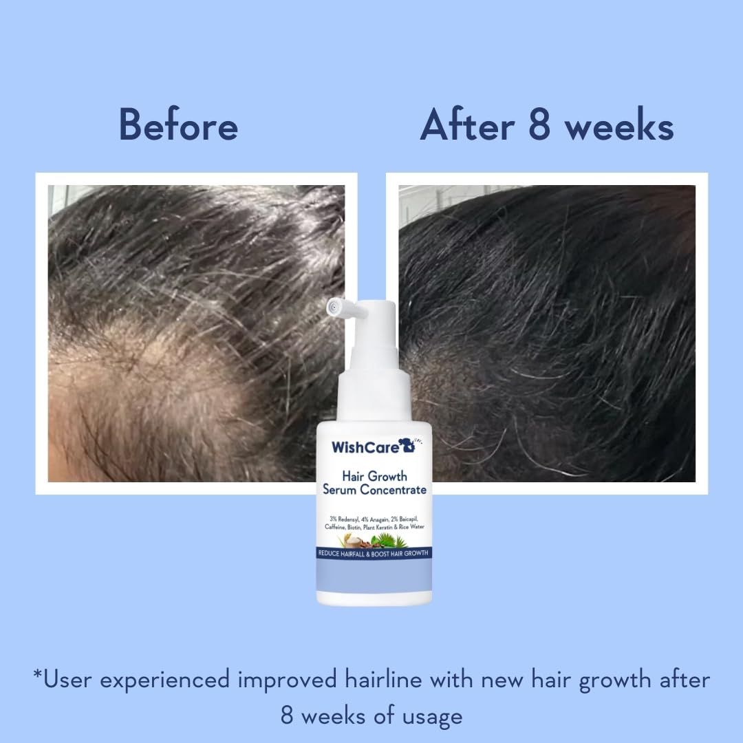 WishCare Hair Growth Serum Concentrate - Rosemary, 3% Redensyl, 4% Anagain, 2% Baicapil, Caffeine, Biotin, Plant Keratin & Rice Water - Medaid International