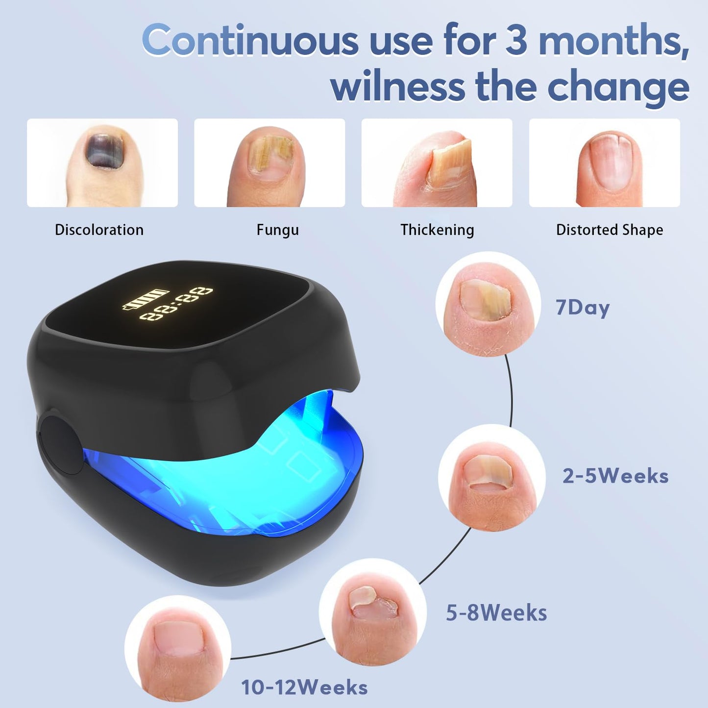 Nail Fungus Laser Treatment Led Light Device - Nail Fungal Infections, Significantly Improve Symptoms Such As Deformation And Painful Walking(black) - Medaid International