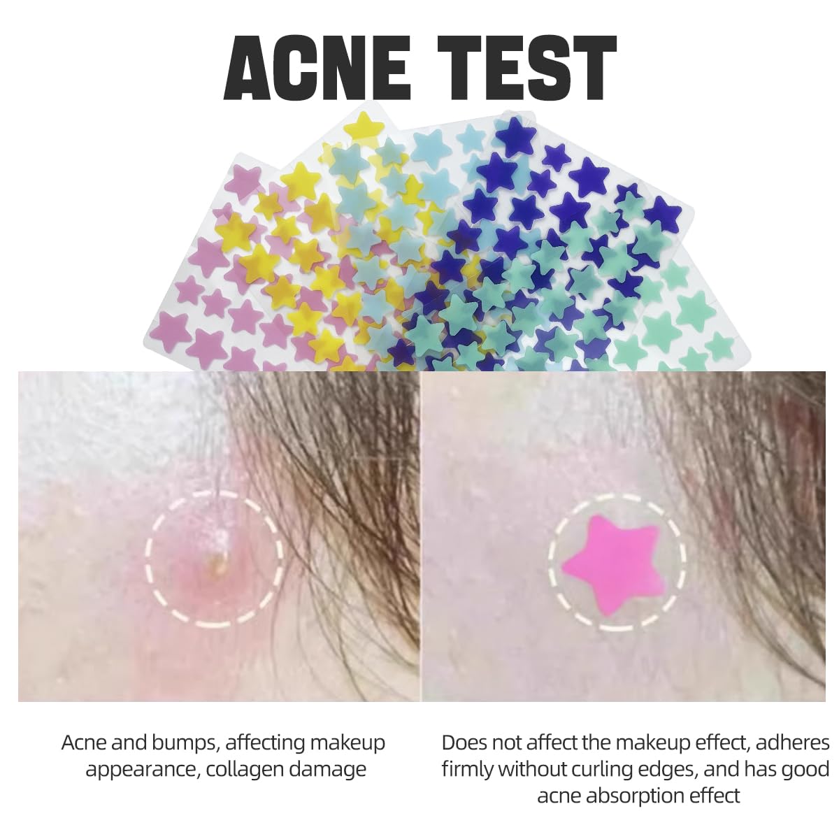 Vavilente Pimple Patches for Face Zit Dots,Hydrocolloid Pimple Patch Star with Tea Tree Oil Acne Patches Invisible,Star Face,Cute Acne Patch-Day and Night Use(200 Count) - Medaid International