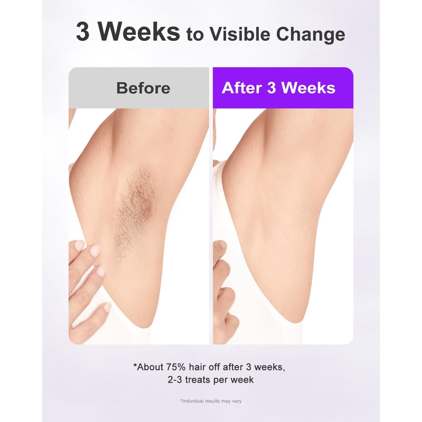 LYSMOSKI IPL Laser Hair Removal Device with Sapphire Ice-Cooling Technology for Women & Men, Painless & Long-Lasting Hair Remover for Full Body Use at Home, Safe on Face, Bikini Line, Armpits, Purple - Medaid International