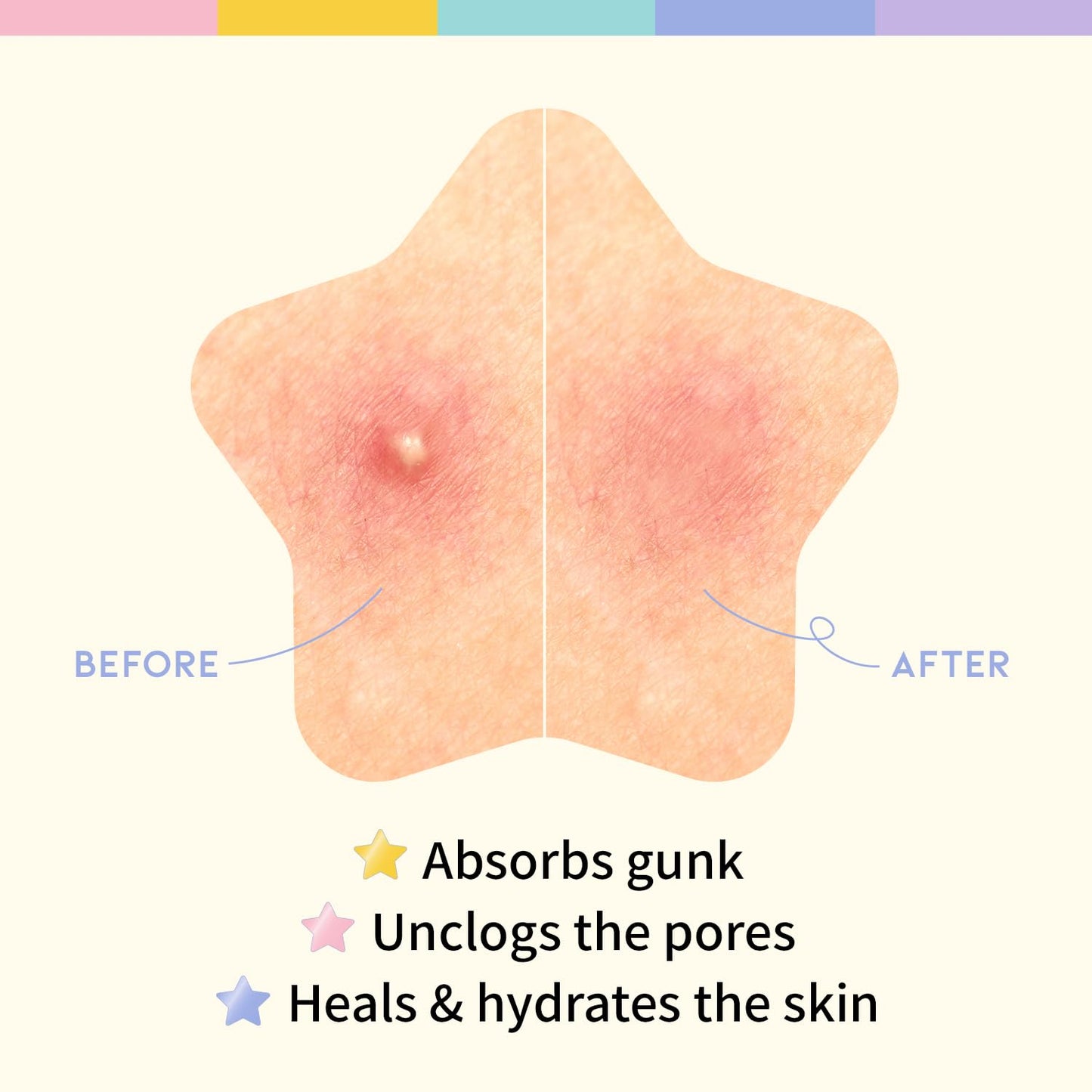 Star Spot Acne/Pimple Patch For Face, Hydrocolloid, Niacinamide, Ceramide, Cute Pastel Colors, Protecting & Healing, Prevent scarring, Blemish remover, Ideal for Blemish Spots, made in Korea 80 counts - Medaid International