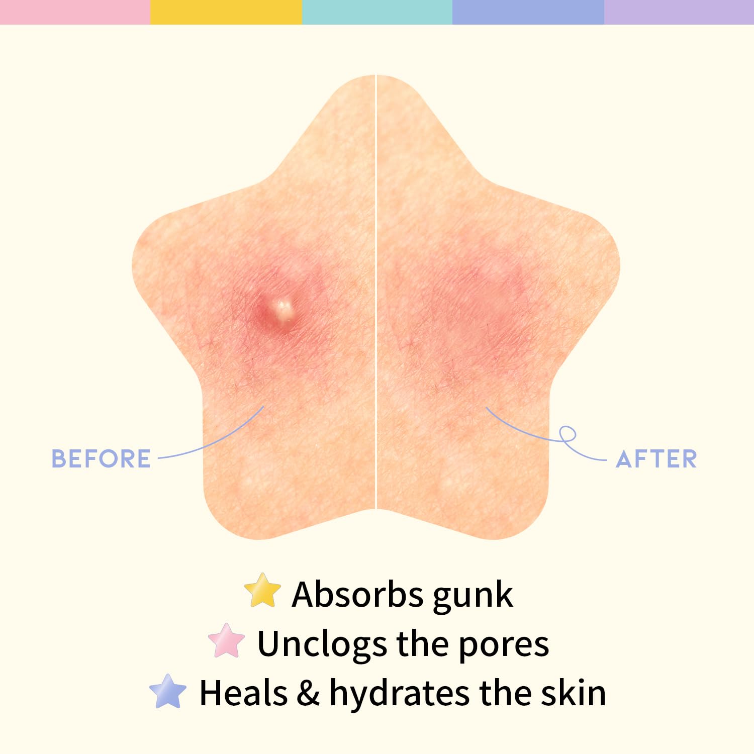 Star Spot Acne/Pimple Patch For Face, Hydrocolloid, Niacinamide, Ceramide, Cute Pastel Colors, Protecting & Healing, Prevent scarring, Blemish remover, Ideal for Blemish Spots, made in Korea 80 counts - Medaid International