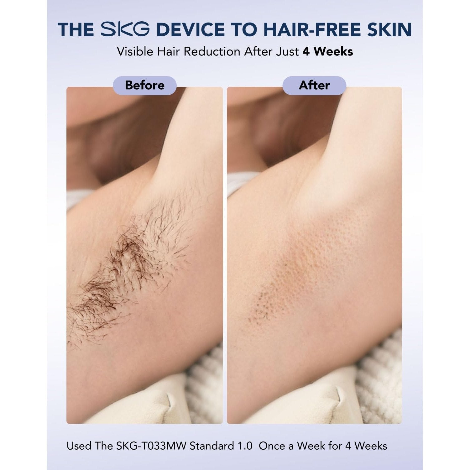 SKG Laser Hair Removal Device for Women Men, at Home Painless IPL Hair Removal with Infinite Flashes, Dual-Pulse, 25 Minutes Rapid Hair Removal, IPL System for Facial Legs Arms Bikini Line Whole Body - Medaid International