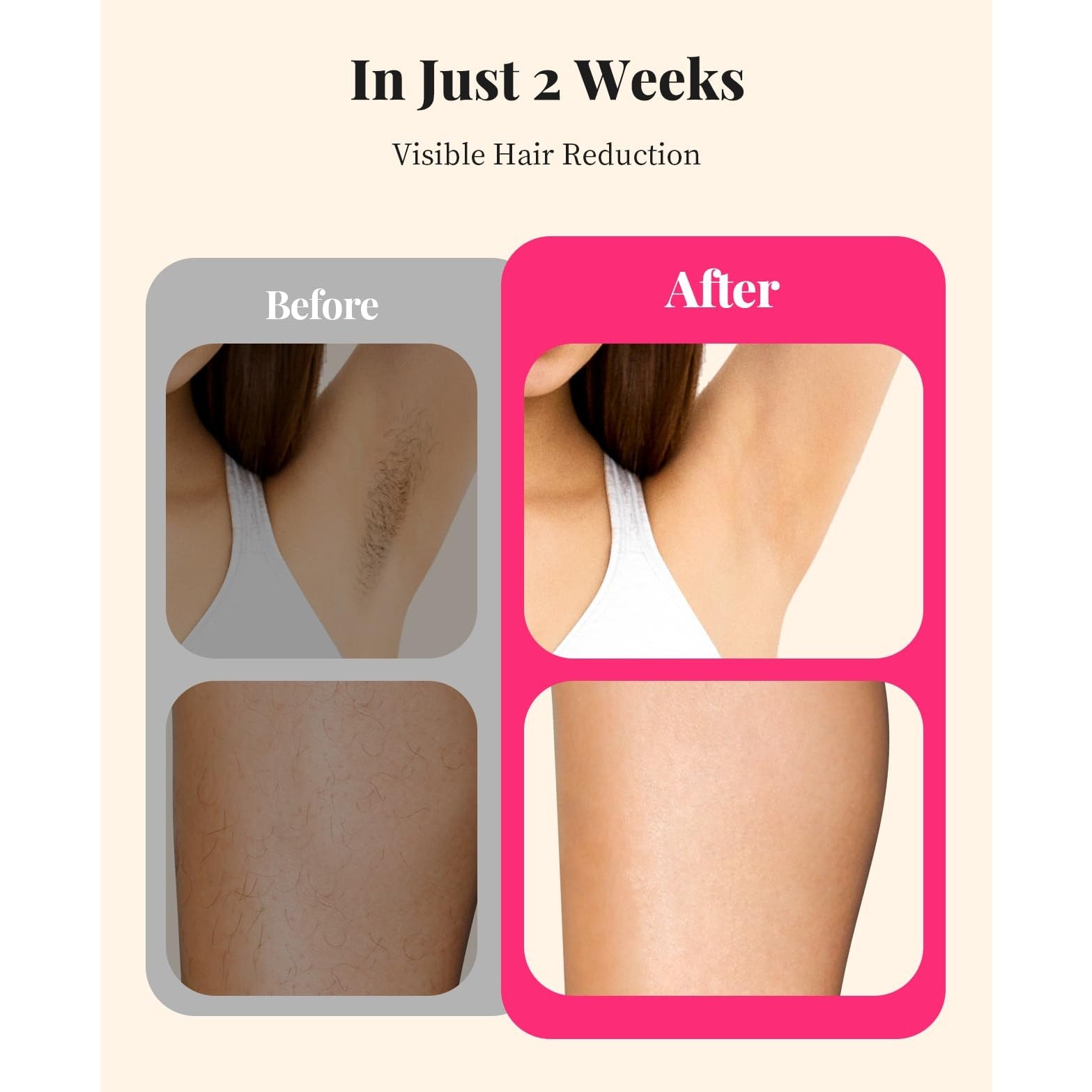 LYSMOSKI Laser Hair Removal for Women and Men, At-Home IPL Hair Removal Device with 5.2 cm² Treatment Window, Nearly Painless, Visible Results in 2 Weeks, Full Body Treatment in 8 Minutes - Medaid International