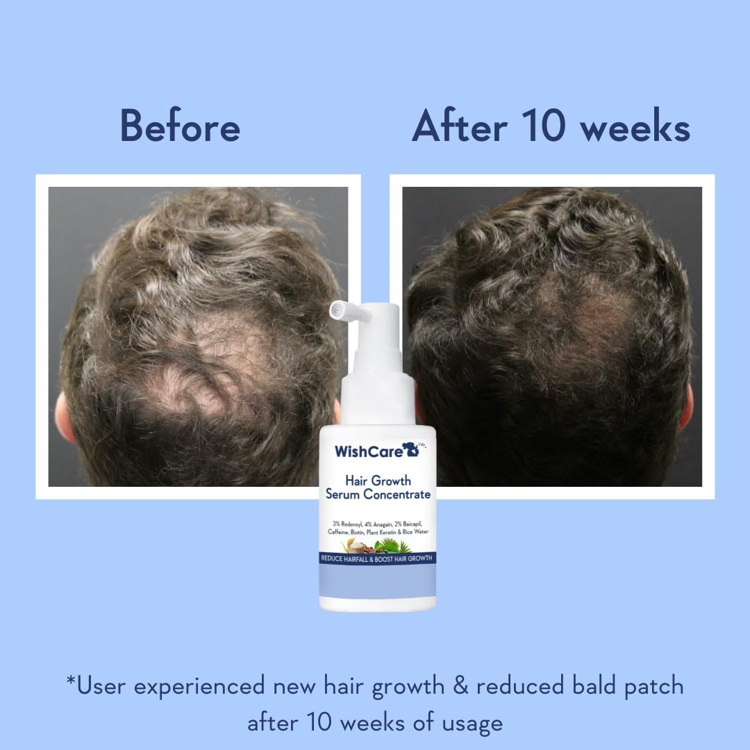 WishCare Hair Growth Serum Concentrate - Rosemary, 3% Redensyl, 4% Anagain, 2% Baicapil, Caffeine, Biotin, Plant Keratin & Rice Water - Medaid International
