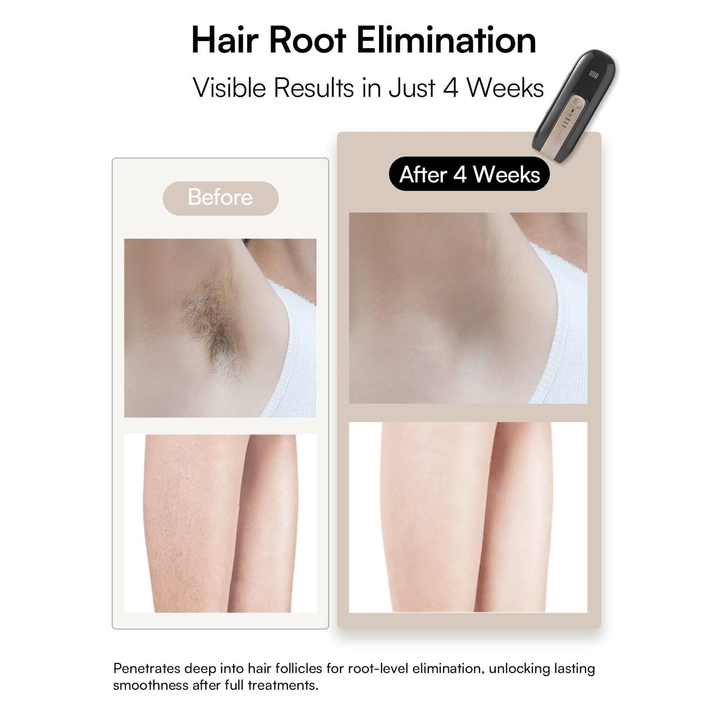 Laser Hair Removal Device for Women and Men, INIA Fond Hair Remover with Long-Lasting in Hair Reduction for Body&Face, Safe at-home Results for Armpits, Bikini and Legs - Medaid International
