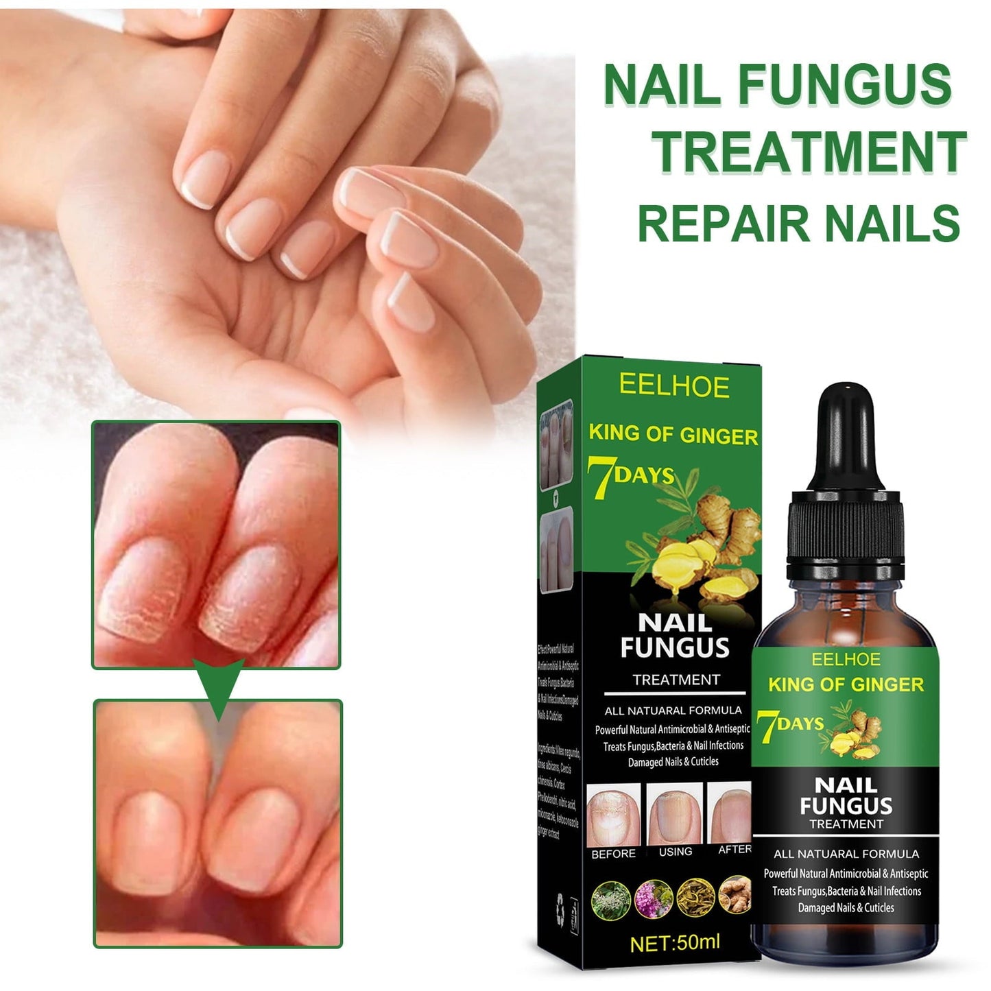 Ginger Nail Fungus Treatment Oil زيت علاج فطريات الأظافر بالزنجبيل