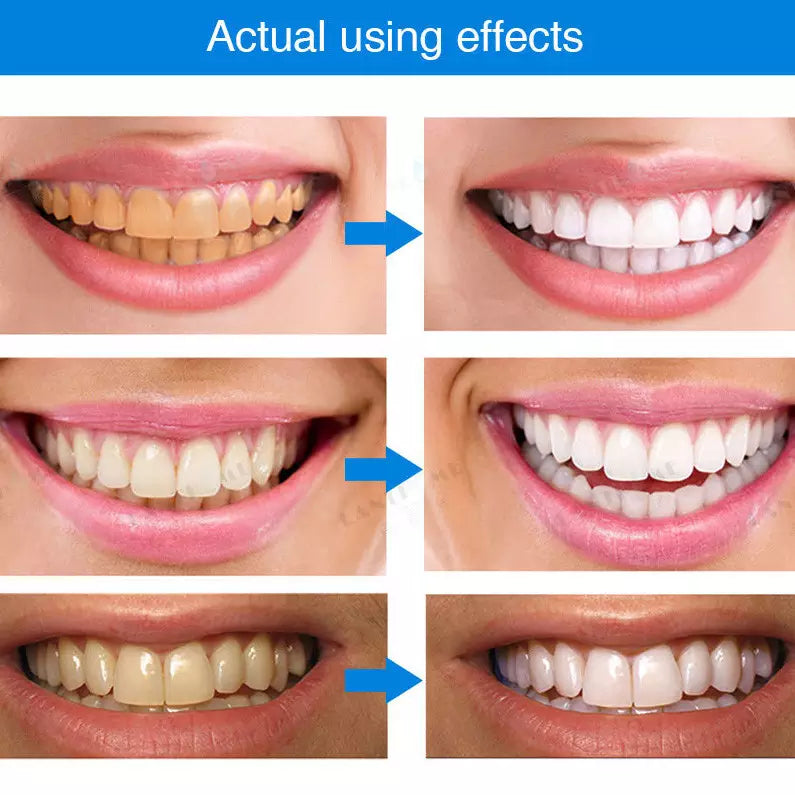 Teeth Whitening Pen