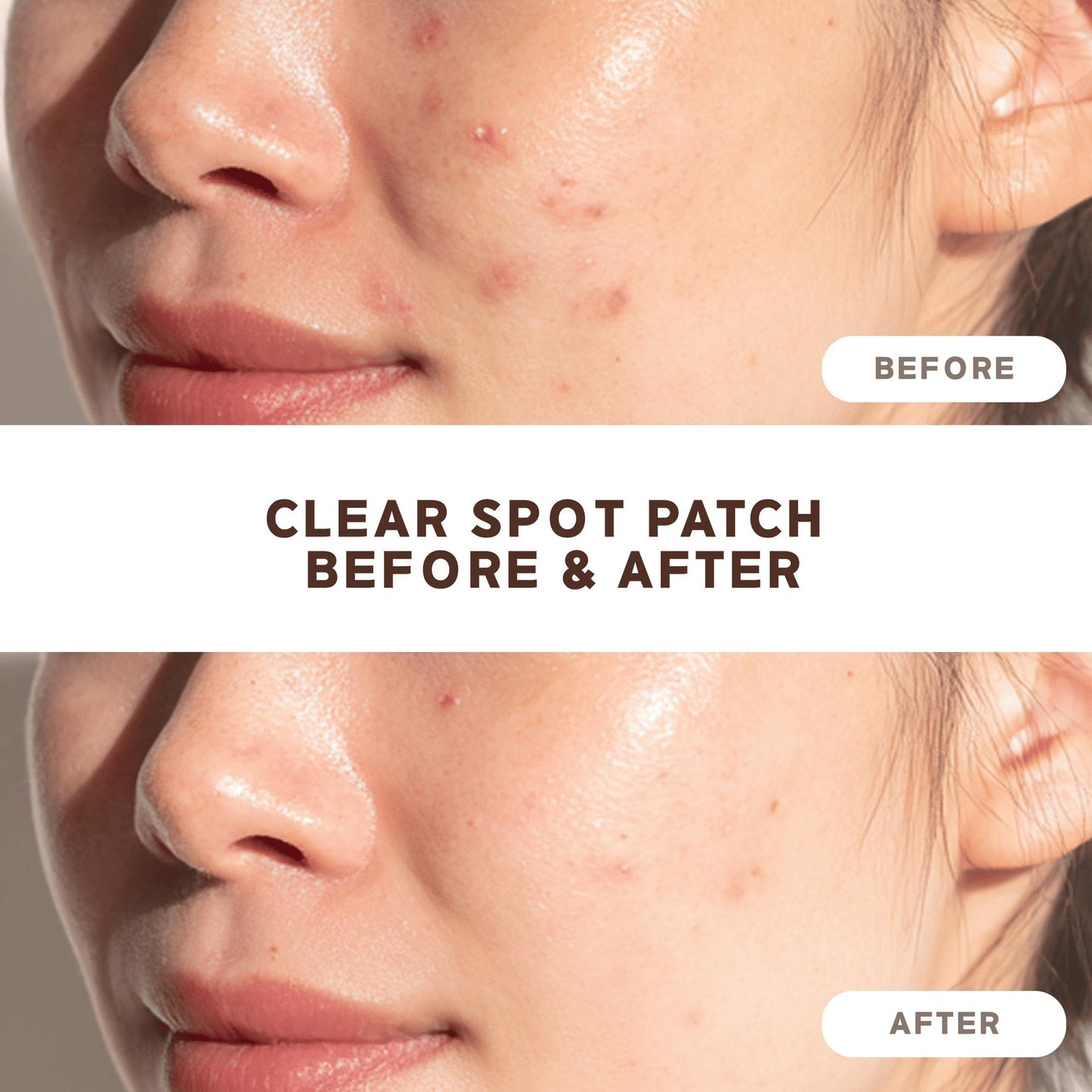 NOLAHOUR Pimple Clear Spot Patch 26 Patches (Daytime Protects & Covers Zits, Transparent) - Medaid International