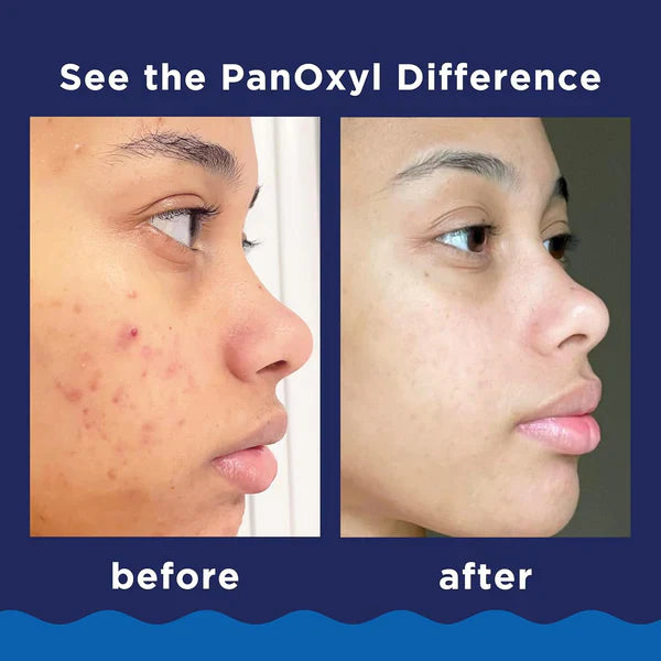 PanOxyl Acne Foaming Wash 10% Benzoyl Peroxide Maximum Strength Antimicrobial