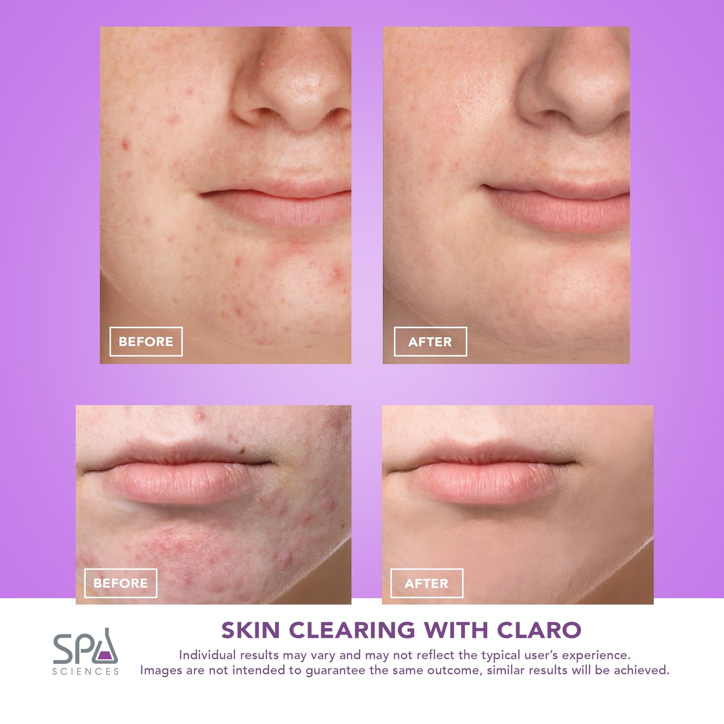Spa Sciences CLARO Clinically Proven Blue & Red LED Acne Treatment Light Therapy System-FDA Cleared-Rechargeable- Professional Home Acne Healing/Clearing Treatment - Medaid International