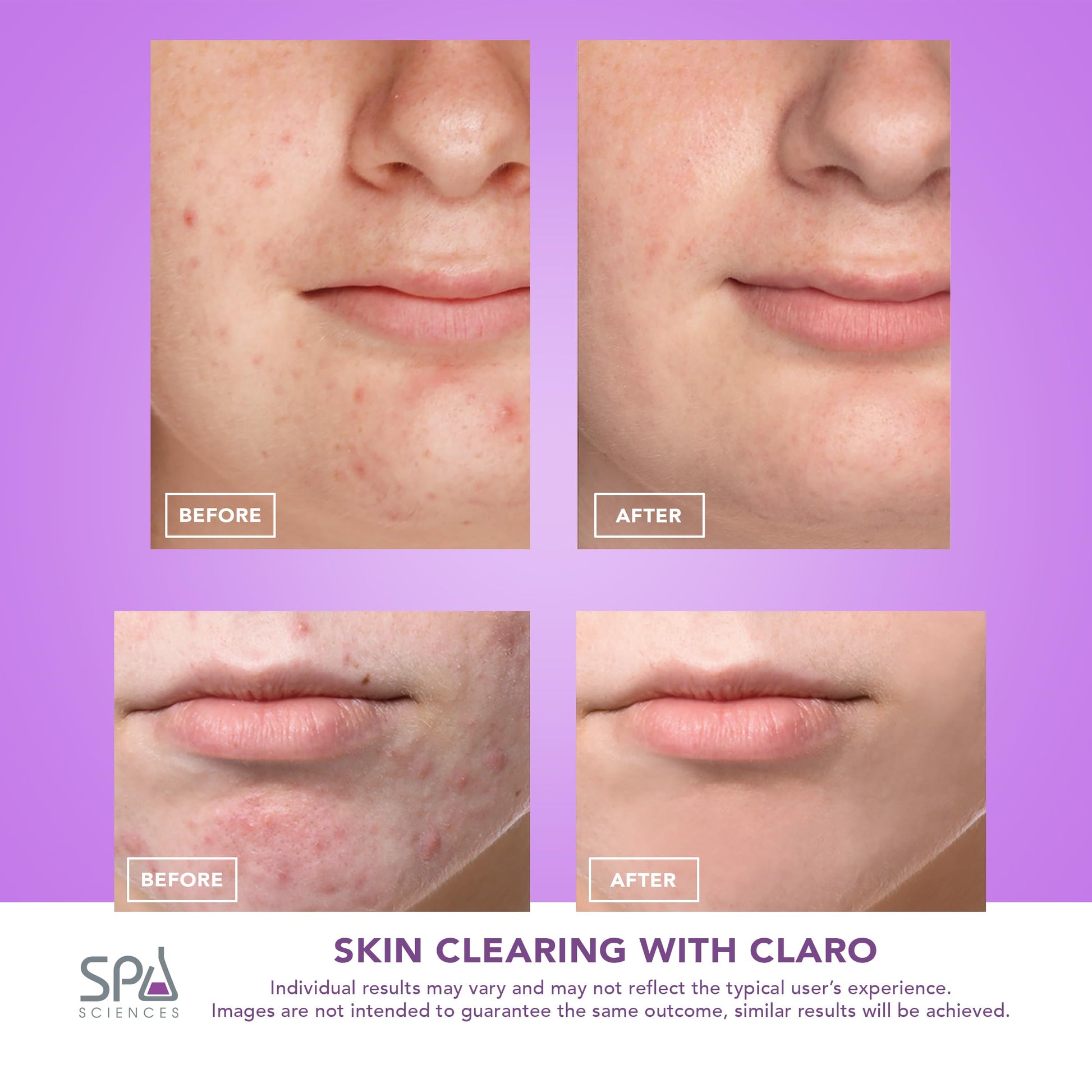 Spa Sciences CLARO Clinically Proven Blue & Red LED Acne Treatment Light Therapy System-FDA Cleared-Rechargeable- Professional Home Acne Healing/Clearing Treatment - Medaid International