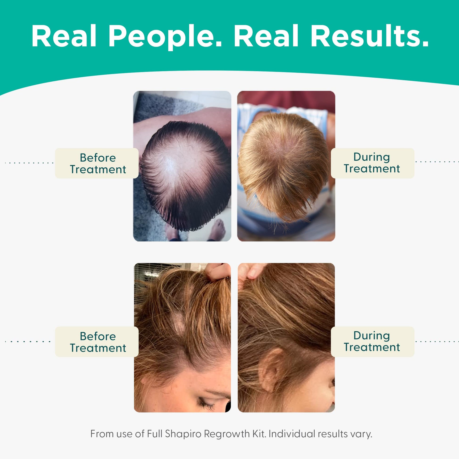 Shapiro MD Hair Growth Experts Leave-In Daily Foam, DHT Fighting Vegan Formula for Thinning Hair Developed by Dermatologists, Experience Healthier, Fuller & Thicker Looking Hair - 4 Month Supply - Medaid International