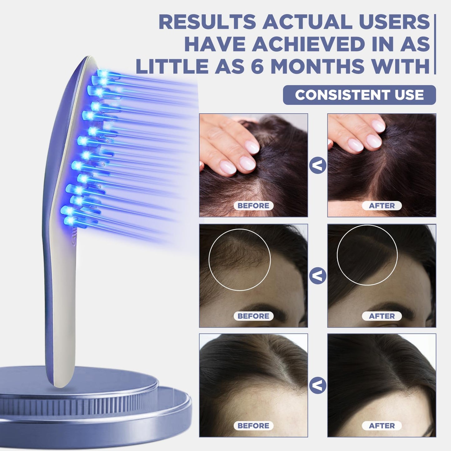 Laser Therapy Hair Growth Comb Model:Lasercomb-001, Hand-held Comb-Shaped Low Level Laser Therapy Device That emits Laser Light Designed to Promote Hair Growth in Women and Men. - Medaid International