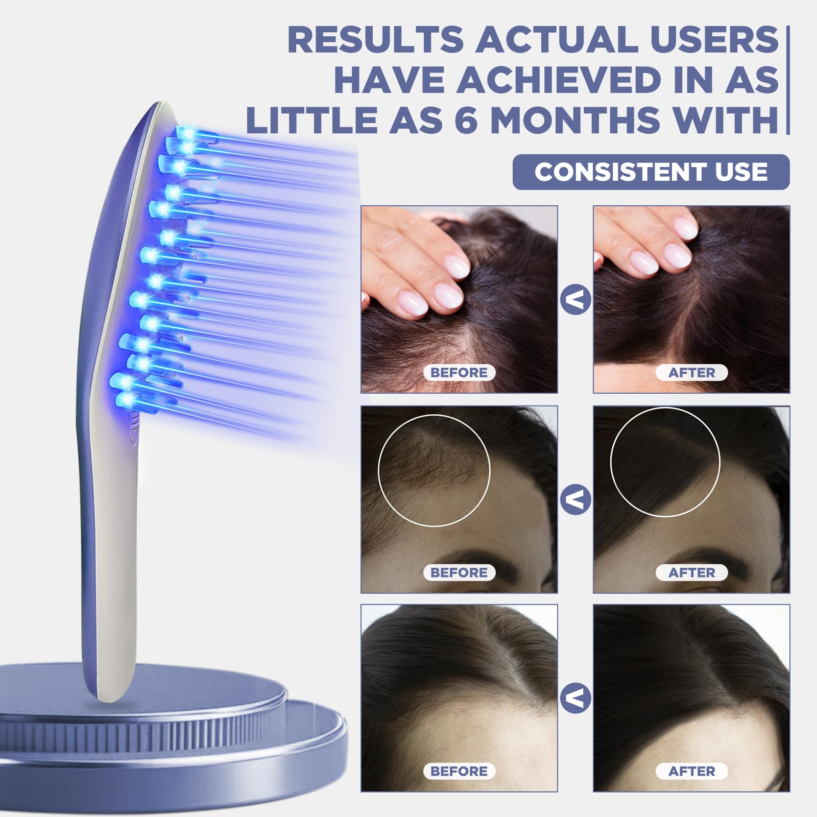 Laser Therapy Hair Growth Comb Model:Lasercomb-001, Hand-held Comb-Shaped Low Level Laser Therapy Device That emits Laser Light Designed to Promote Hair Growth in Women and Men. - Medaid International