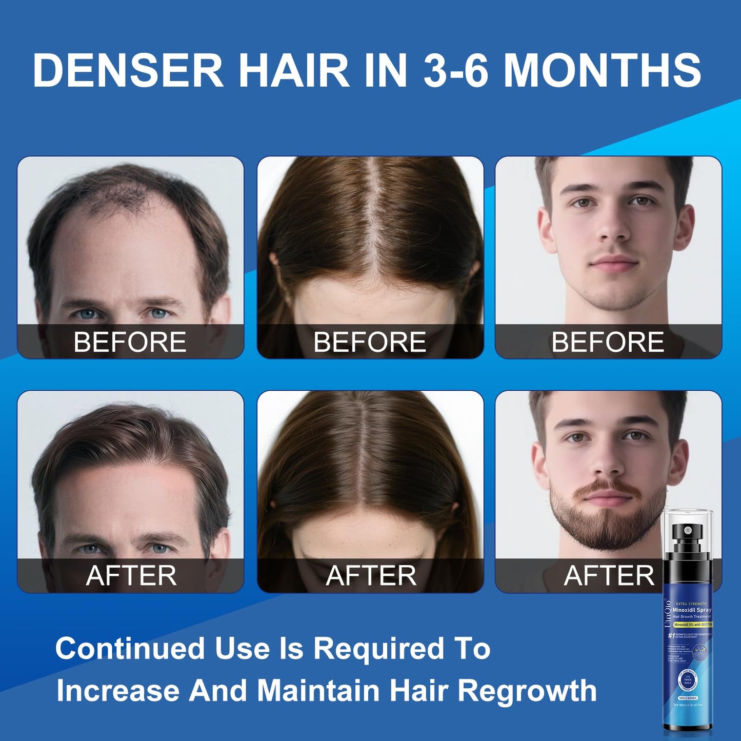 5% Minoxidil Spray for Men and Women, Infused with Biotin, for Hair Regrowth Treatment, Beard Growth, Extra Strength Treatment to Combat Hair Loss and Thinning, 5 Month Supply, 3 x 3.38 oz - Medaid International