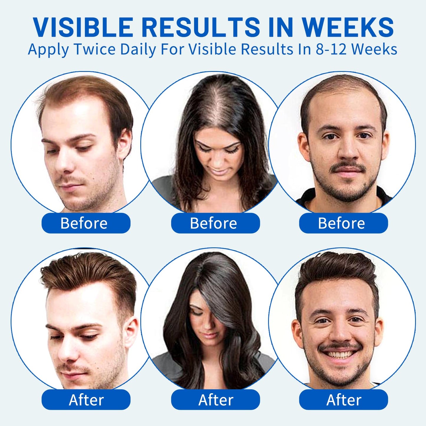 5% Minoxidil Hair Growth Foam for Men & Women – 2 Pack (60ml Each) | Extra Strength Hair Regrowth Treatment with Biotin | Supports Thicker, Fuller-Looking Hair - Medaid International