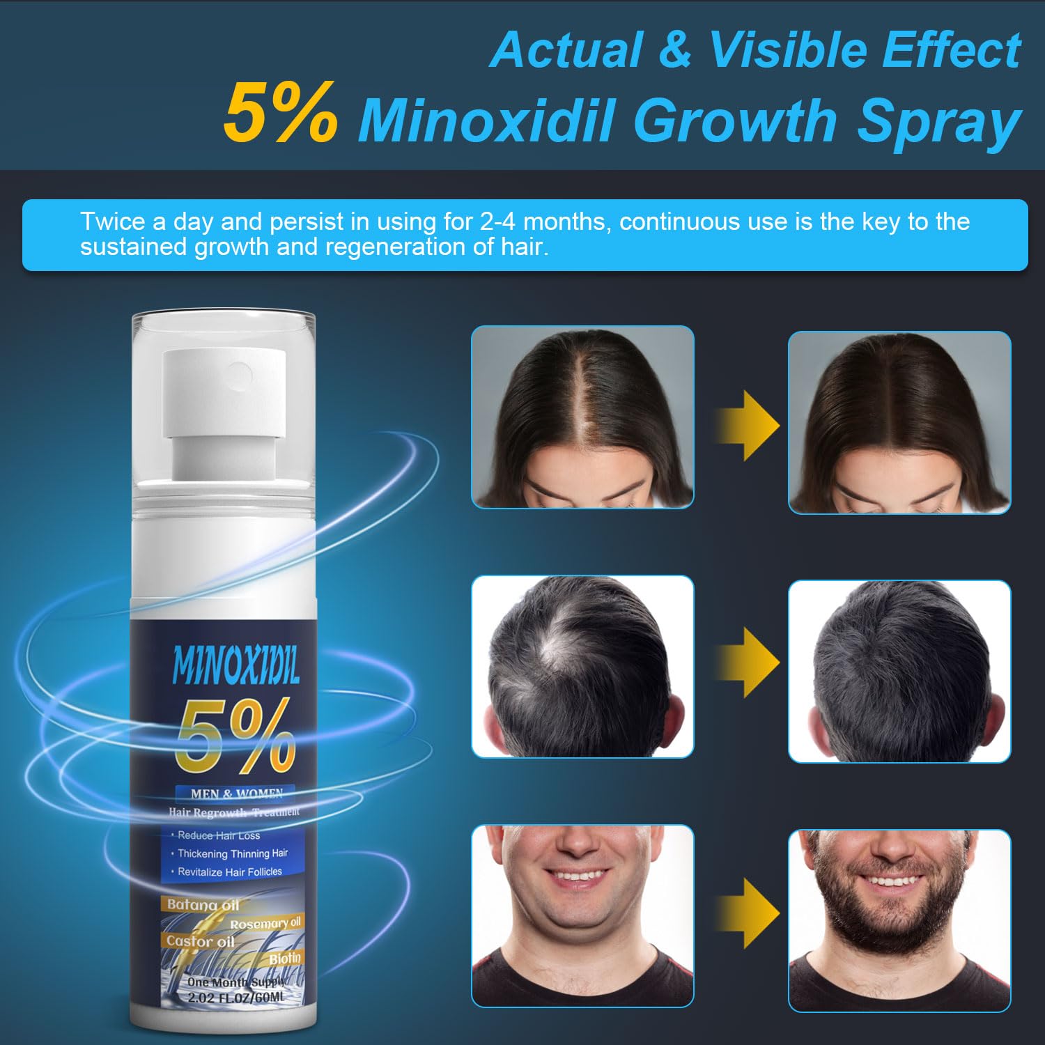 5% Minoxidil for Men and Women, Hair Growth Biotin Serum with Batana and Rosemary for Hair beard Regrowth Treatments, Extra Strength Hair Loss Solution to Regrow Thicker, 2.02FL OZ - Medaid International
