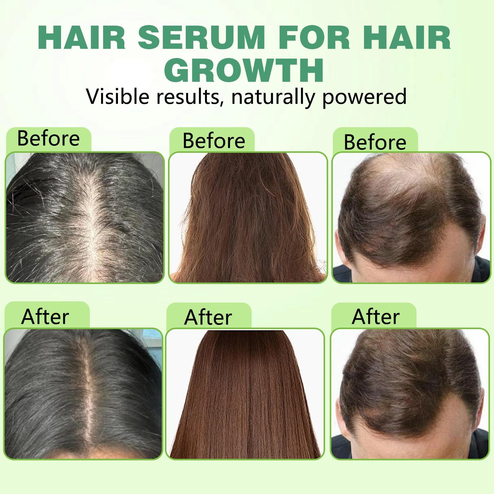Hair Regrowth System, Advanced Hair Growth Treatment Ginseng, Eclipta Prostrata,Peppermint Oil & Ginger Root,Strengthens Hair Roots,Thickening Serum for Men & Women (1 Set) - Medaid International