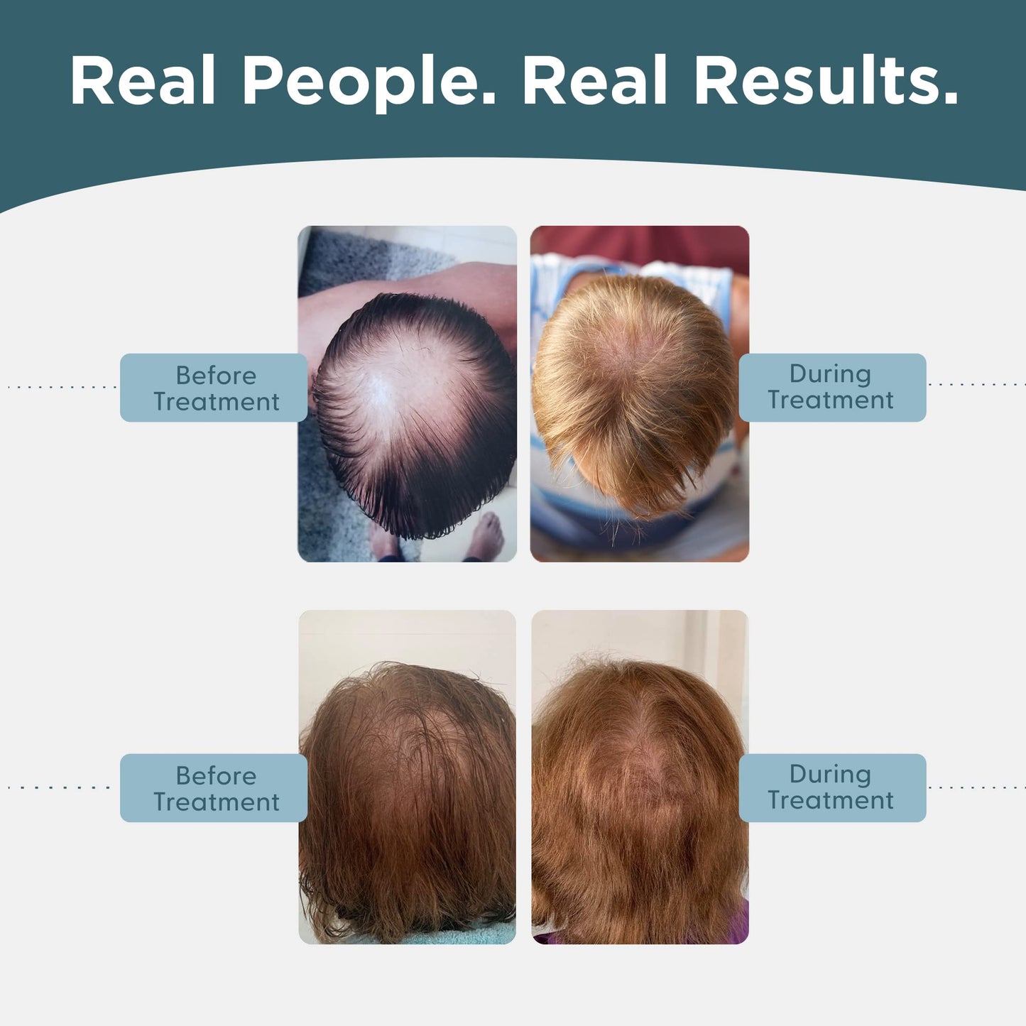 Shapiro MD Hair Growth Experts Minoxidil 5% Topical Solution for Men's Hair Growth, Serum Promotes Hair Regrowth by Reactivating Hair Follicles - 1 Month - Medaid International