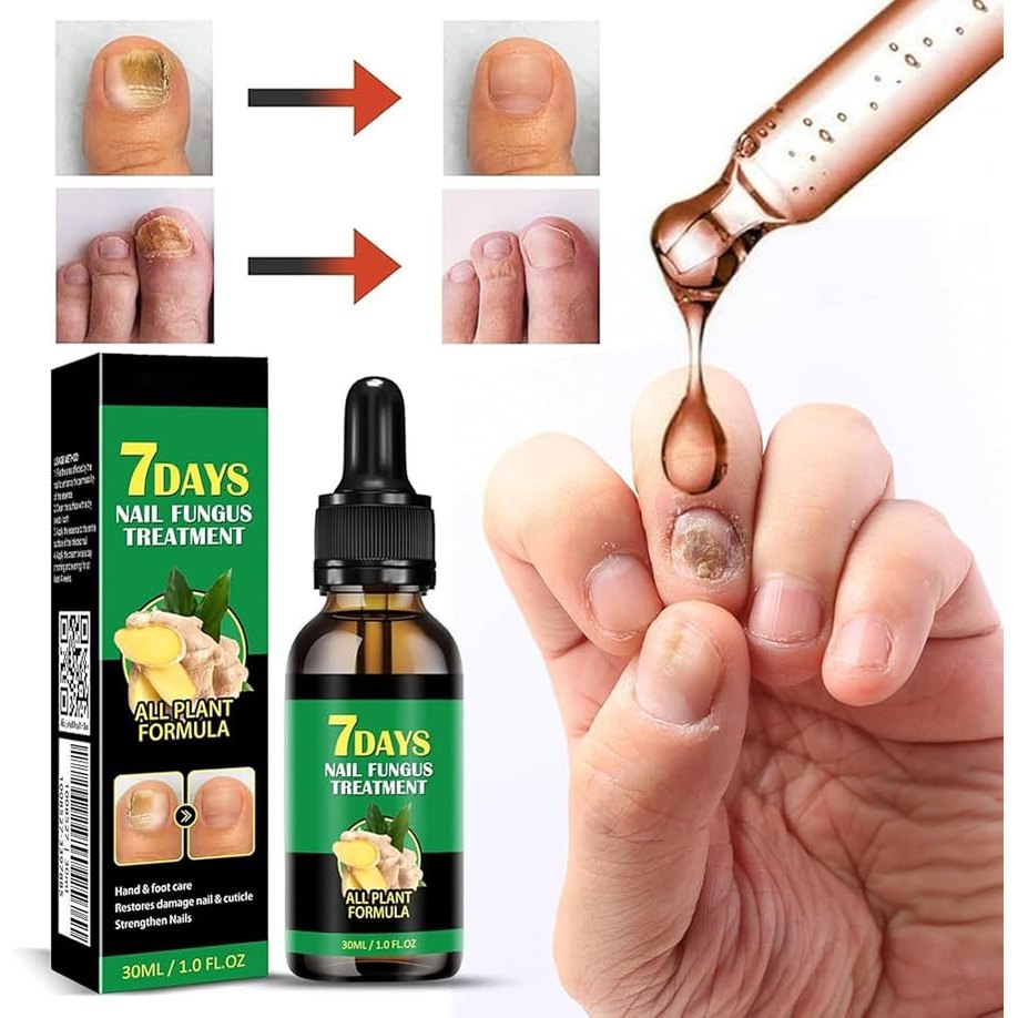 Ginger Nail Fungus Treatment Oil زيت علاج فطريات الأظافر بالزنجبيل