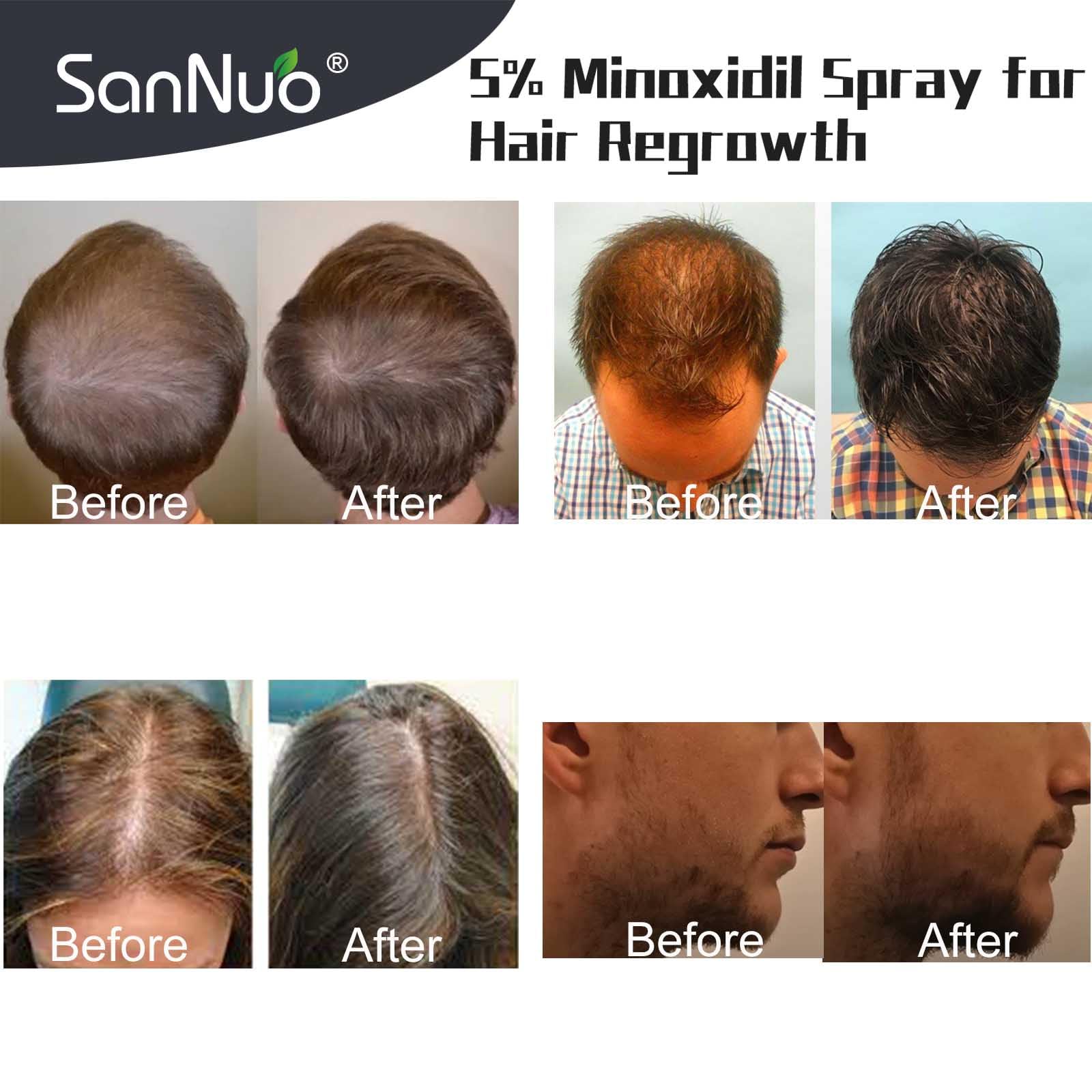SANNUO 5% Minoxidil Hair Growth Spray for Men and Women Hair Regrowth Treatment for Stronger Thicker Longer Hair Help to Stop Thinning and Loss Hair 1 Month Supply, 60mL(1 Pack of 60mL) - Medaid International