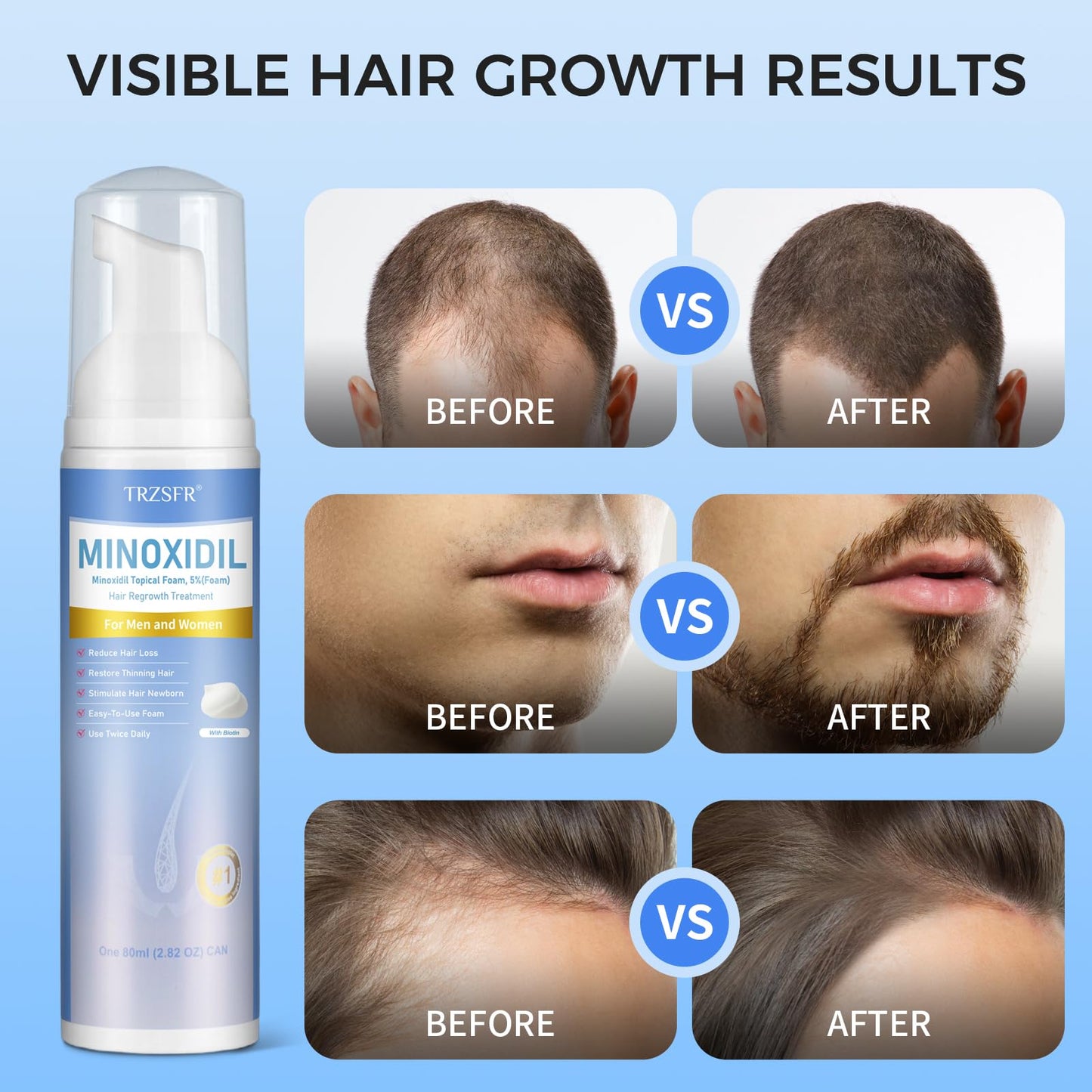 Trzsfr 5% Minoxidil Foam for Men & Women, Hair Regrowth Treatment for Thinning Hair & Beard Growth, Extra Strength Topical Foam, Clinically Proven Hair Loss Treatment, 6 Month Supply (14OZ Total) - Medaid International