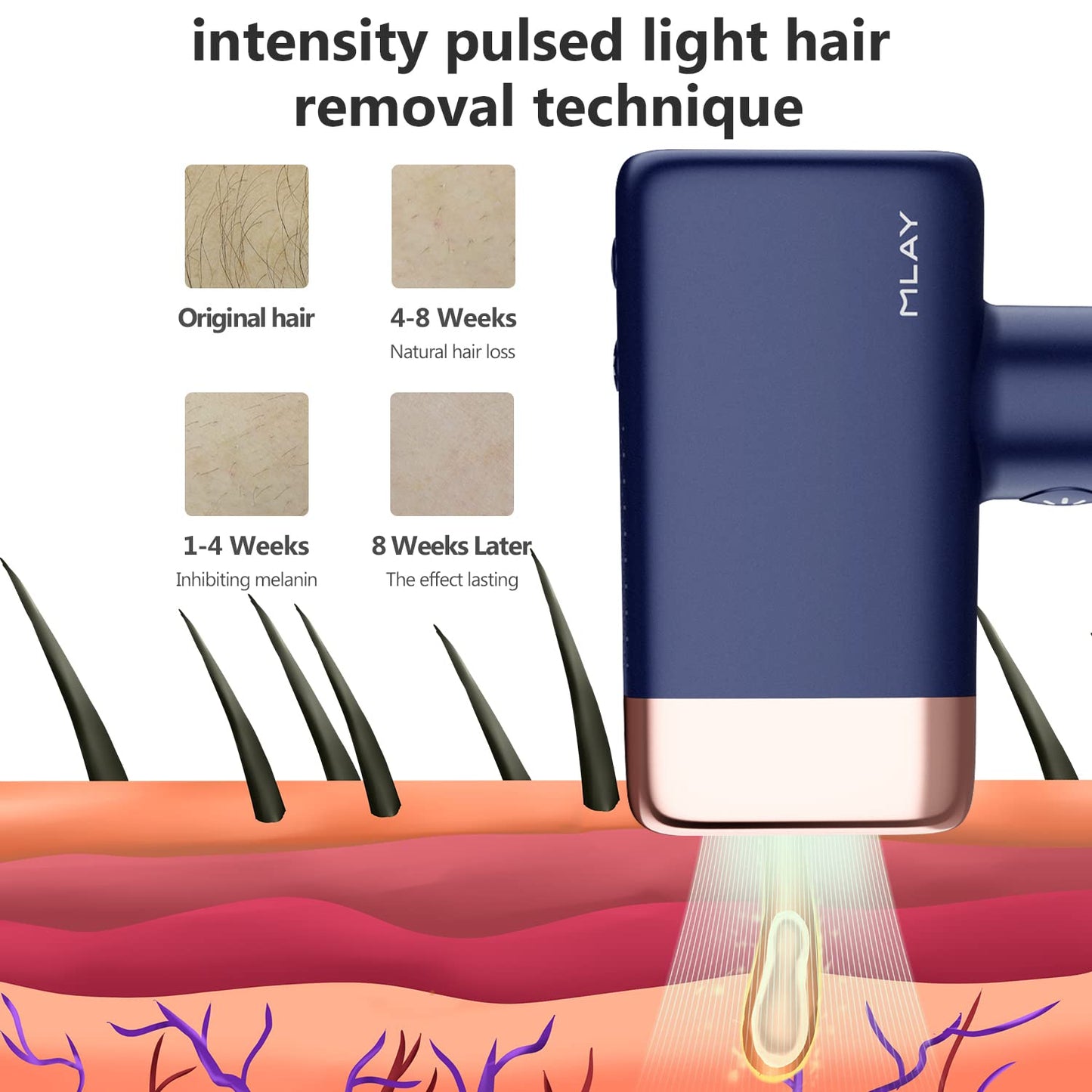 MLAY IPL Hair Removal Device, Ice Cooling Protection Laser Whole Body Hair Remover for Home Use Women and Men (1*HR+1*Bikini HR) - Medaid International