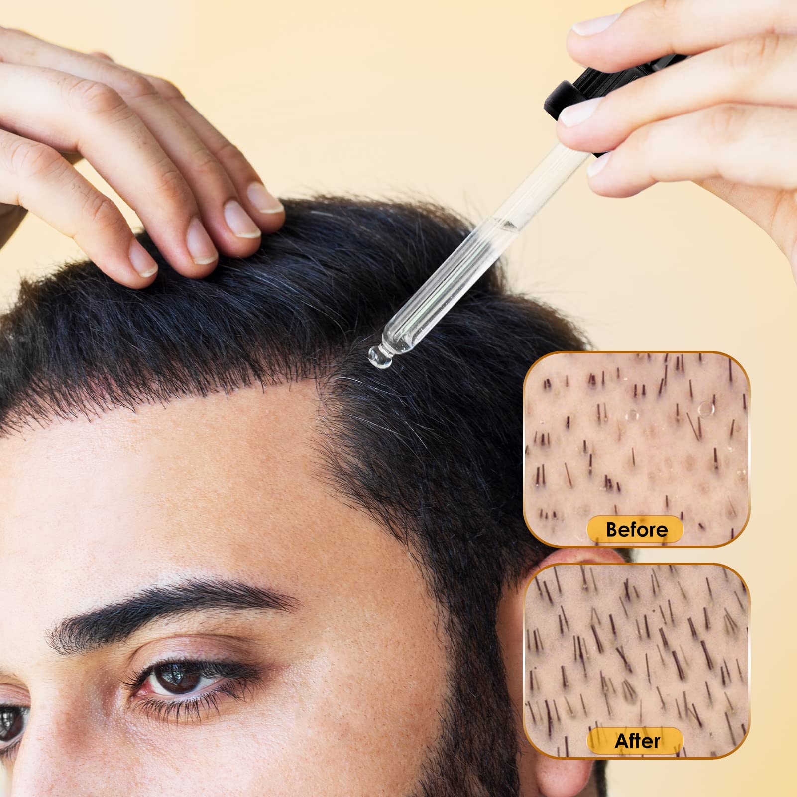 5% Minoxidil for Men & Women Hair Growth - Biotin Minoxidil Serum Oil for Beard Growth Stop Hair Thinning and Hair Loss For Stronger Thicker Longer Hair - Medaid International